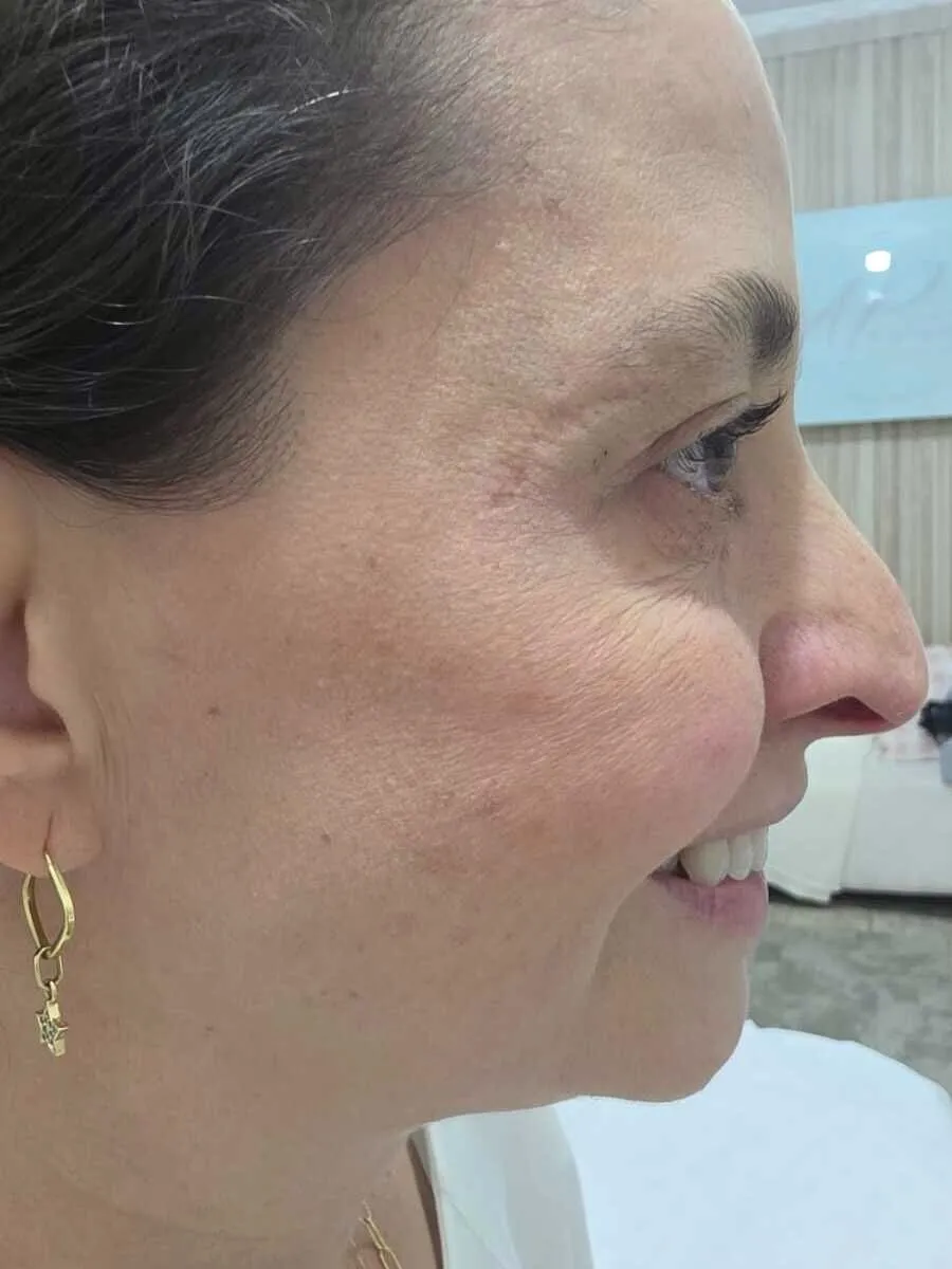 Depois — Botox — Contorno dos Olhos