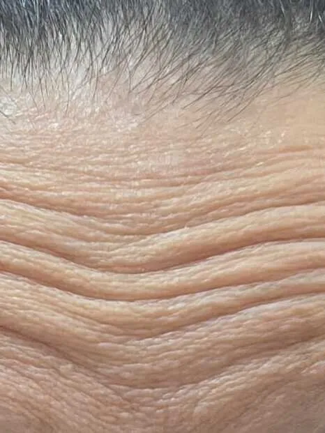 Antes — Botox — Testa