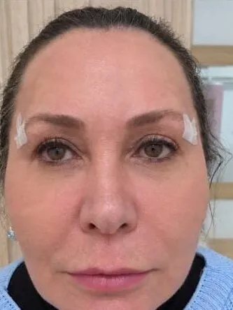 Depois — Rosto Frontal (8 dias)