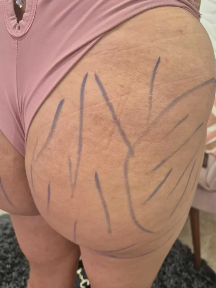 Antes — Estética Corporal