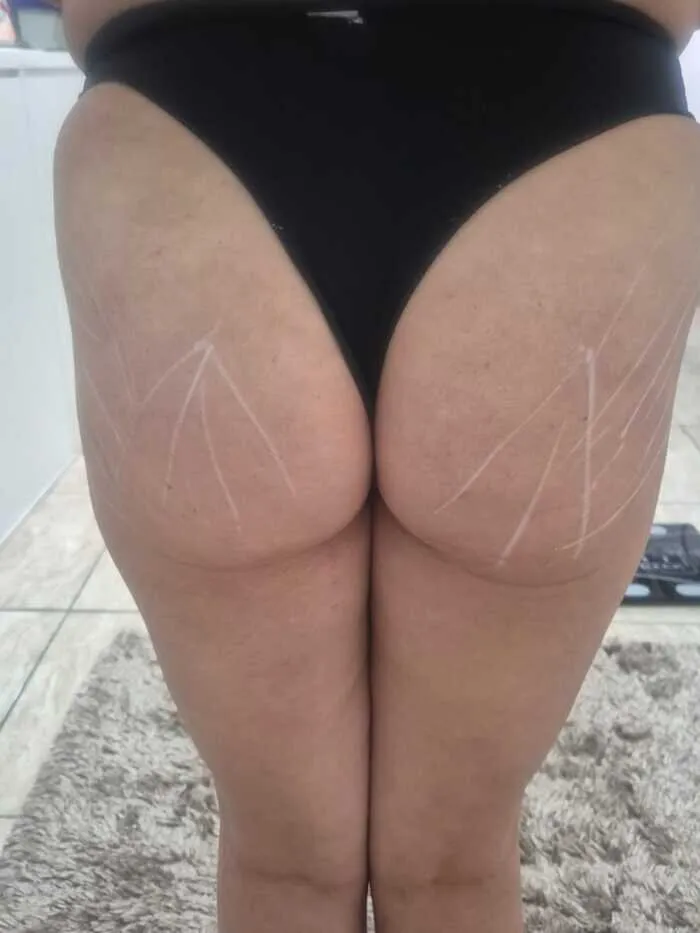 Antes — Estética Corporal