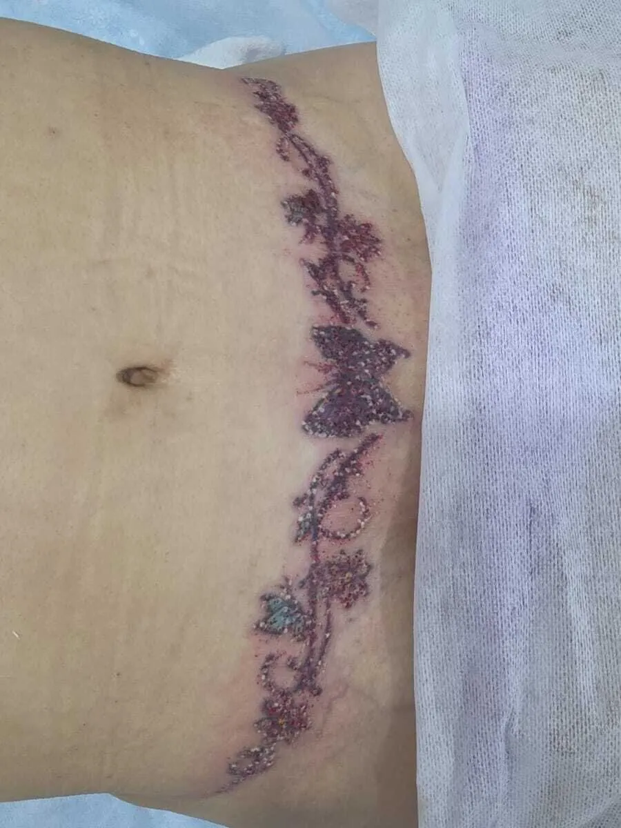 Depois — Remoção de Tatuagem
